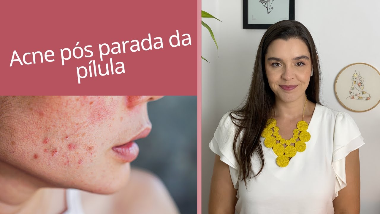 Acne pós parada da pílula, parei  pílula e tive acne, o que fazer? Com tratar acne pós pílula.