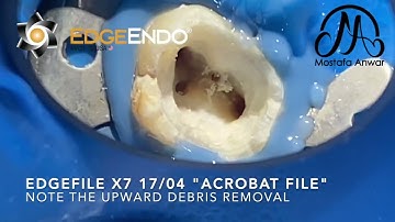 Management of Calcified MB2 Canal in Upper Second Molar using EDGE ENDO X7 Rotary Files | Manualless