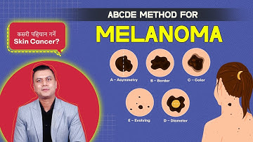 Melanoma Explained | How I Detect Skin Cancer Using the ABCDE Method