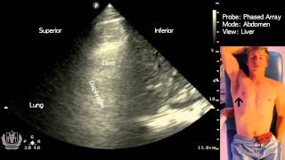 Abdominal Ultrasound - Basics of Evaluating the Liver