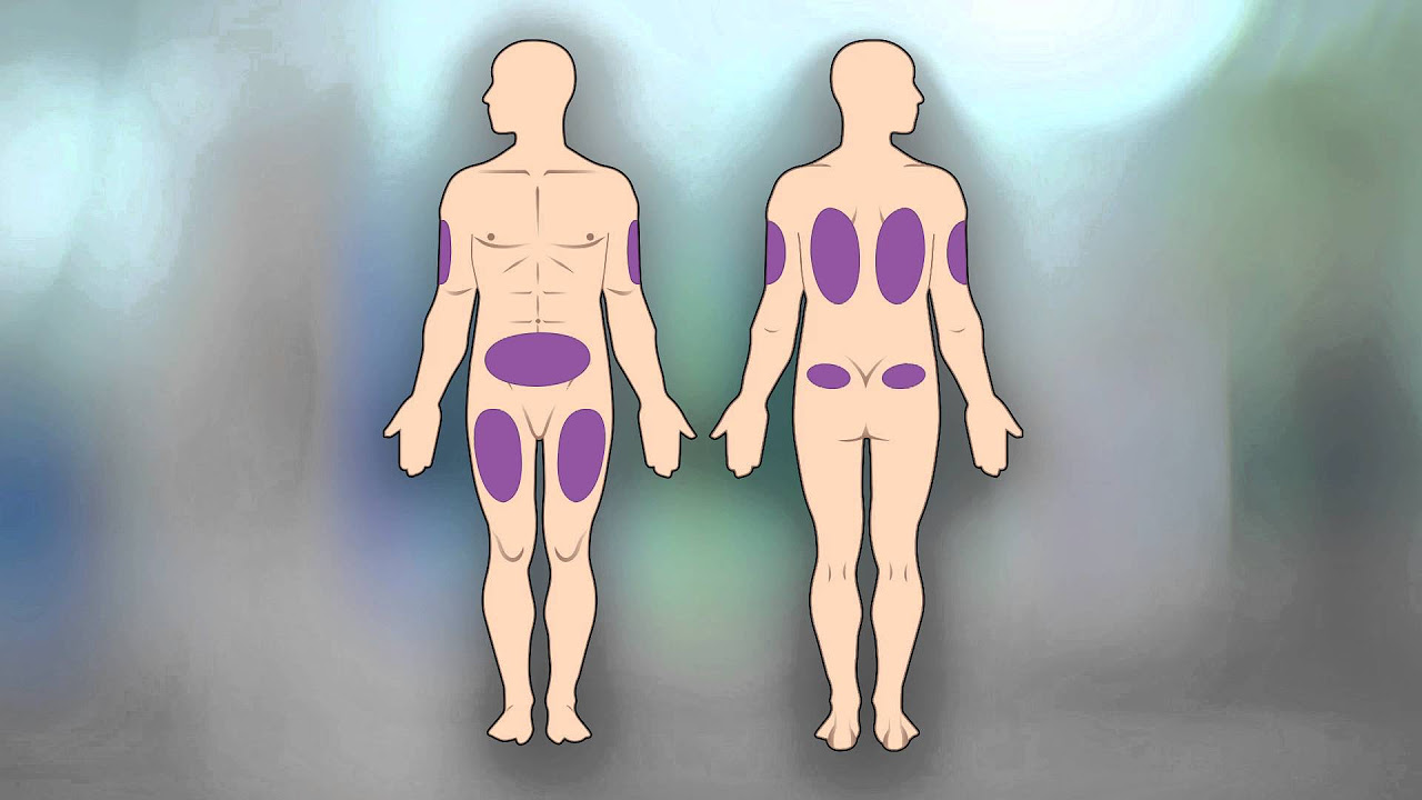 Subcutaneous injection.