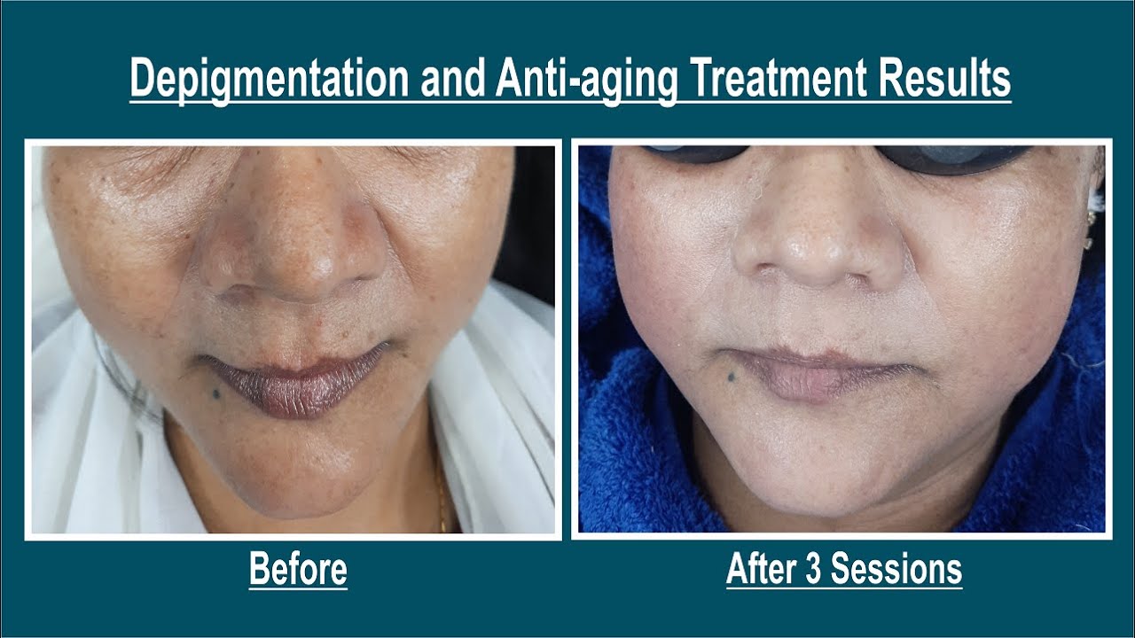 glutathione supplementation and skin pigmentation laser hair removal L-Glutathione (Reduced), 500 mg, 50 Quick Release Capsules main image 0