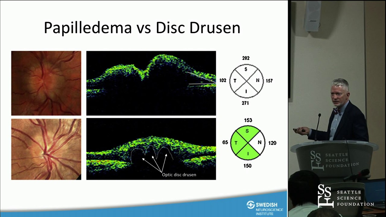 Use of Visual Fields and Optical Coherence Tomography in Neurosurgery - Steven R. Hamilton, MD