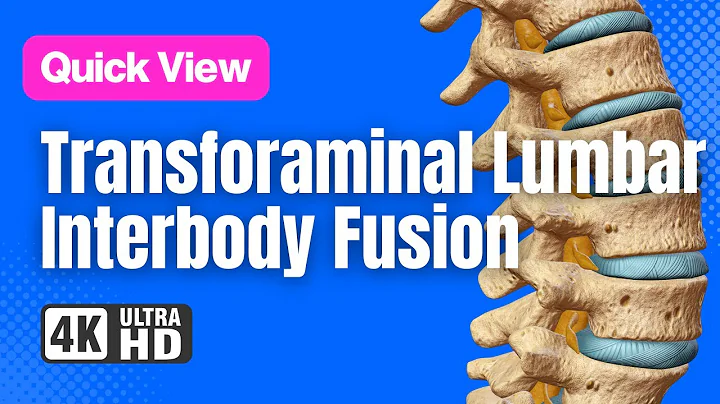 Transforaminal Lumbar Interbody Fusion (TLIF) // See How It Works // 3D Animation