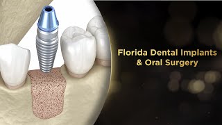 Single Dental Implant Procedure with Bone Grafting