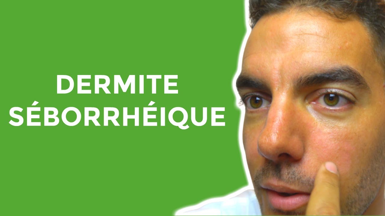 Dermite Séborrhéique Traitement : Les Produits que j'utilise pour me  Soigner !