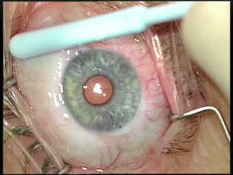 Implante Xen con MMC en paciente con glaucoma uveítico fáquico