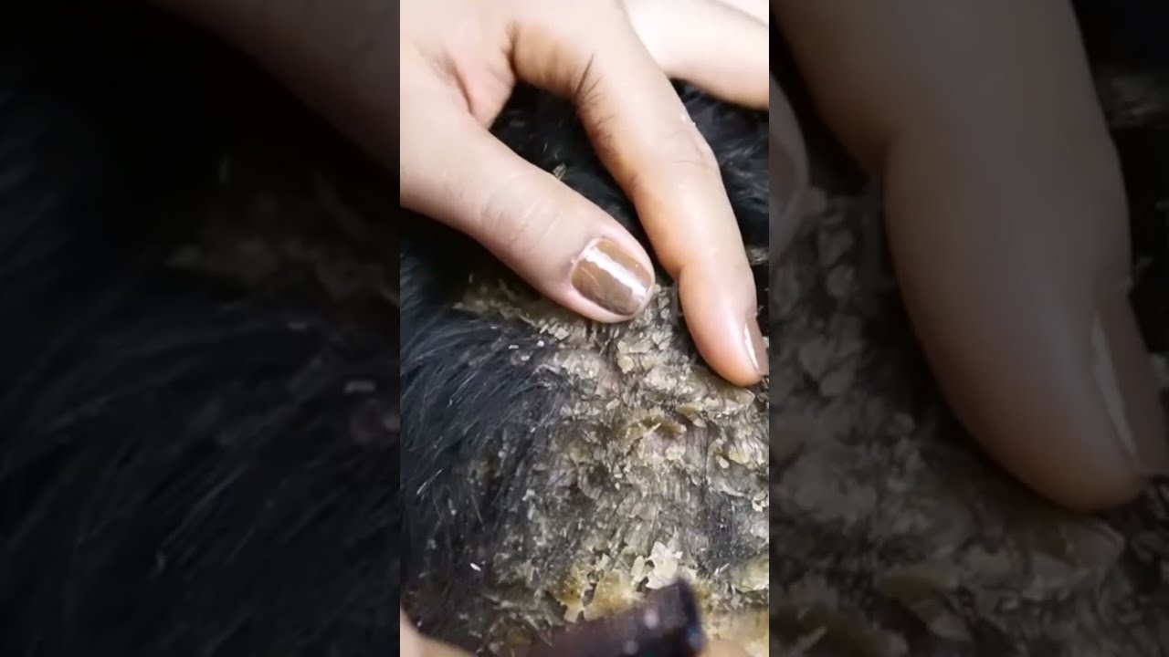 Scratching Dandruff Remove On Head