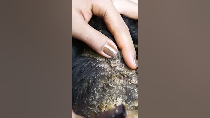 Scratching dandruff remove on head