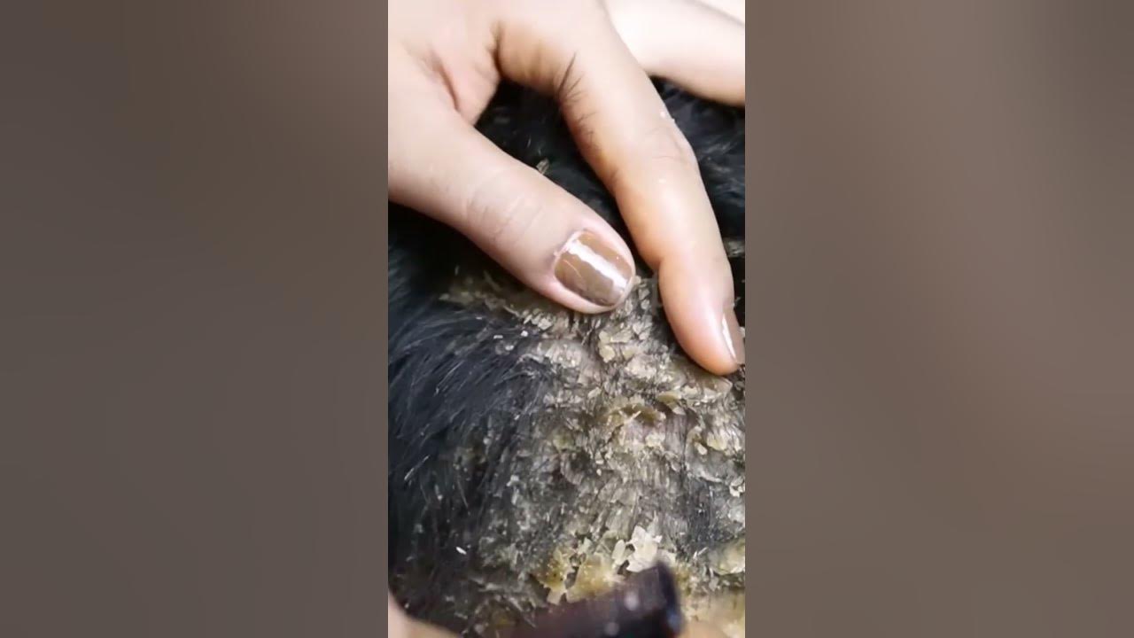 Scratching dandruff remove on head