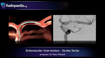 Stroke: Endovascular management of ischaemic stroke - radiology video tutorial