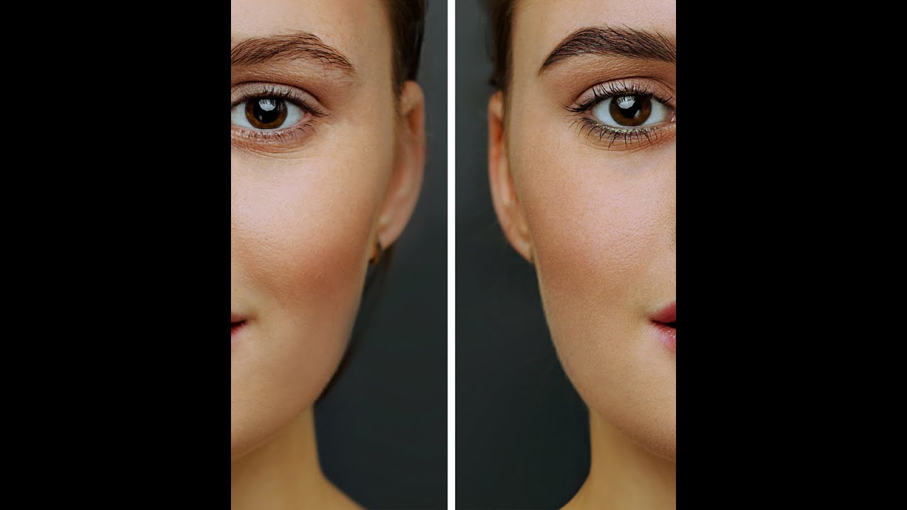 Injections acide hyaluronique - Maison Marignan