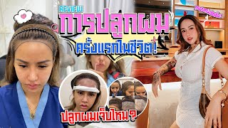 รีวิว..การปลูกผมครั้งแรกในชีวิต แบบไม่ต้องพักฟื้น ไม่เจ็บ?