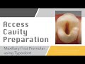 ACCESS CAVITY PREPARATION OF MAXILLARY FIRST PREMOLAR