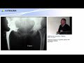 Treatment choices in a geriatric patient with acetabulum fracture