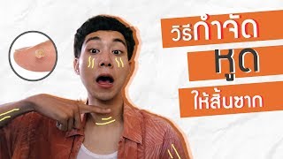 กำจัดหูดให้สิ้นซาก !!! | 12iwKira