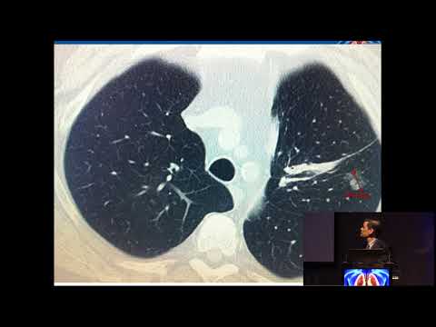 Vídeo: Biopsia Con Aguja Pulmonar: Propósito, Procedimiento Y Riesgos