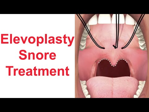 Elevoplasty Snore Treatment