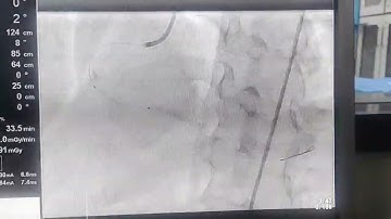 CTO (chronic total occlusion) of RCA #cardiology #education #medicaldoctor #medicine #angiogram