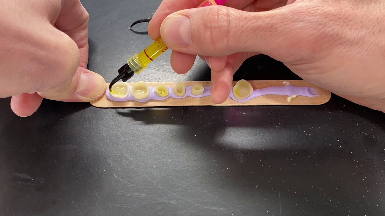 How to Hold Emax Crowns/Veneers During Prep for Bonding YouTube