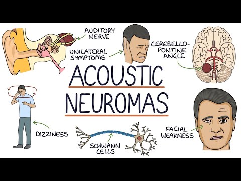 Understanding Acoustic Neuromas