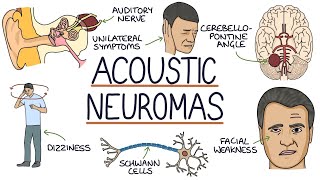 Understanding Acoustic Neuromas