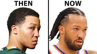 Hair Surgeon Reacts To Jalen Brunson's Hair Loss