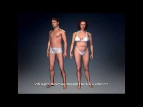 Despre Liposuctie cu Ultrasunete Vaser - VIDEO