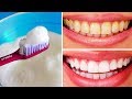 10 Modi Naturali per Sbiancare i Denti a Casa
