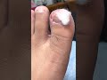 Ep_4061Ingrown toenail removal 👣 จิ้มปุ๊บ..ออกมาเลย 😁 (clip from Thailand)