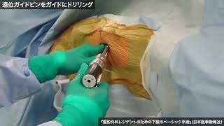 動画2-1：大腿骨頚部骨折：ハンソンピン挿入