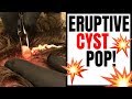 ERUPTIVE CYST POP!
