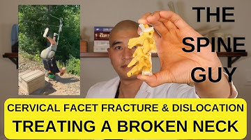 Treating A Broken Neck - Cervical Facet Fracture & Dislocation