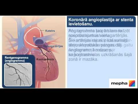 Koronārā angioplastija ar stenta ievietošanu