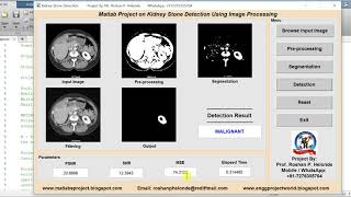 Matlab Code for Kidney Stone Detection Using Image Processing - Kidney Stone Analysis Using Matlab