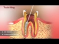 Root Canal Treatment