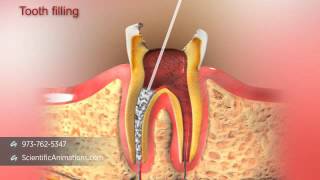 Root Canal Treatment