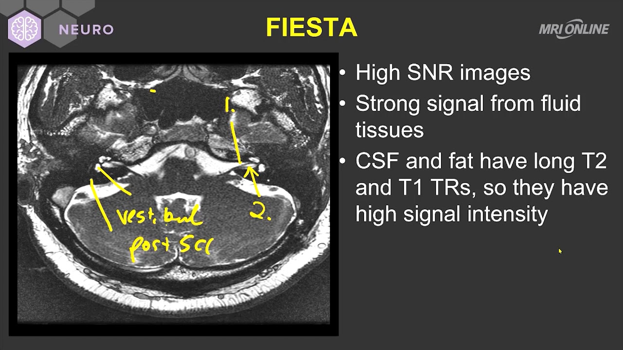 Technique on MRI - Inner Ear MRI - MRI Online - YouTube