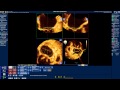 How to use Mitral Valve Quantification (MVQ) software of Q-Lab