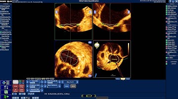 How to use Mitral Valve Quantification (MVQ) software of Q-Lab