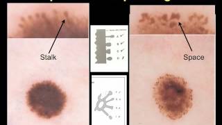 superficial spreading malignant melanoma