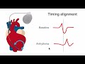 QRS morphology—a 'normal' template