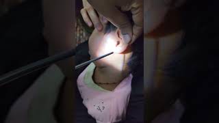 Massive Earwax Removal/ কানের ভিতরের শক্ত ময়লা পরিস্কার(বের) করা/कान का मैल निकालना