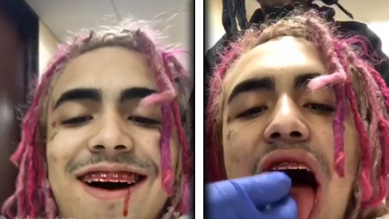 Lil Pump Gets His Wisdom Teeth Removed On Instagram Live - YouTube.
