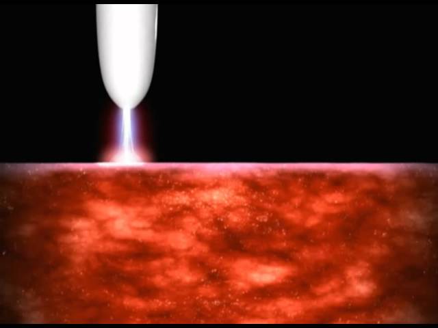 Принцип метода аргоноплазменной коагуляции