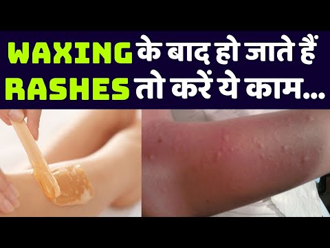 Waxing कराने के बाद आपको भी हो जाते हैं Rashes तो करे ये काम | Boldsky