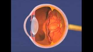 Retinopathy Of Prematurity (ROP) by KMN