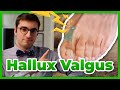 Hallux valgus  : diagnostic, prévention et traitement