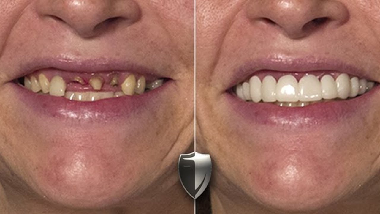 Brighter Image Lab Fear Of Dentist See Incredible Smile Makeover In brighter-image-lab-fear-of-dentist-see-incredible-smile-makeover-in