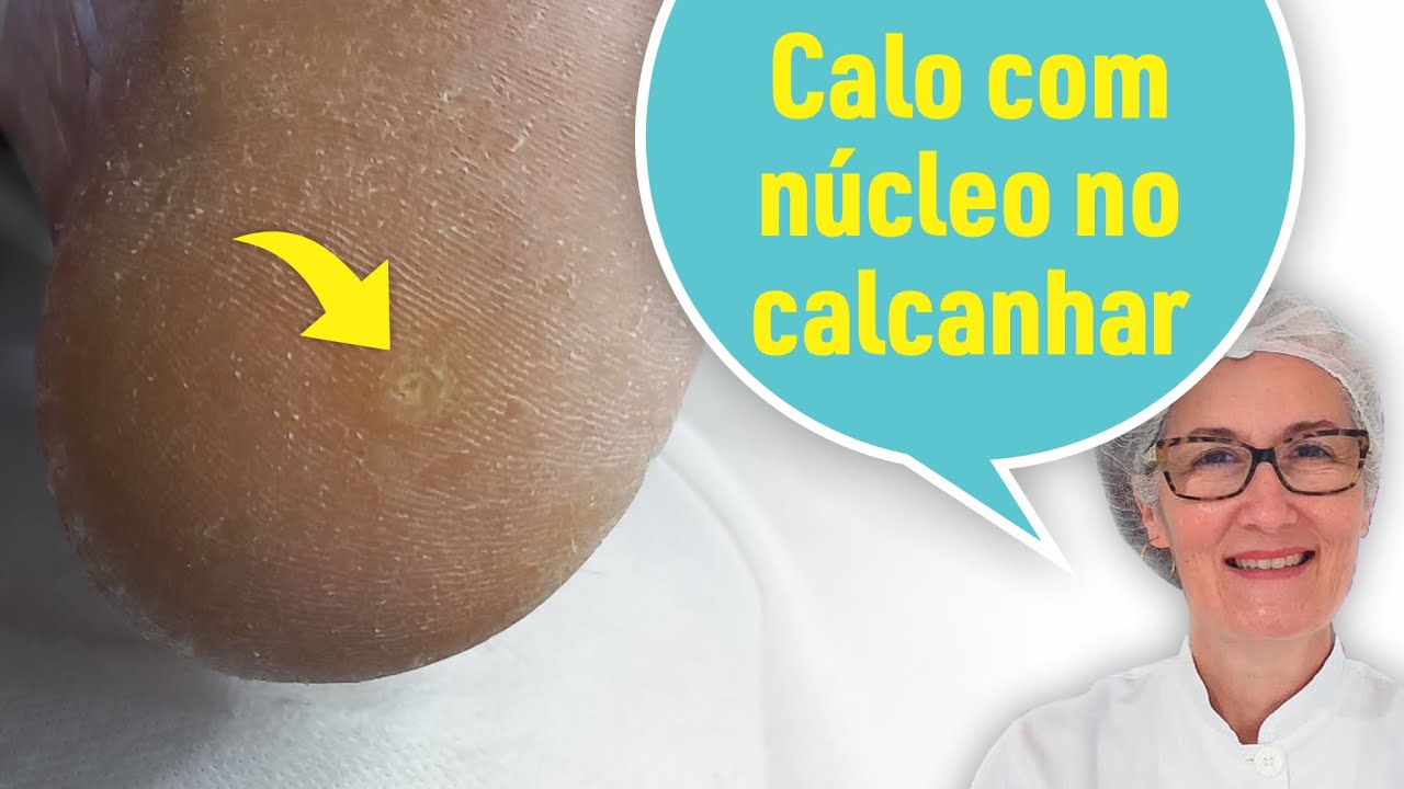 calo-com-n-cleo-no-calcanhar-como-fazer-a-podologia-youtube